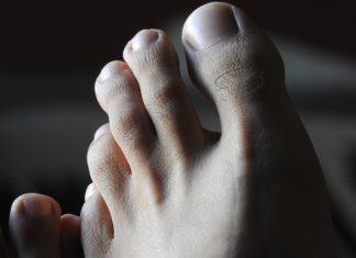 Grzybica paznokci stóp
